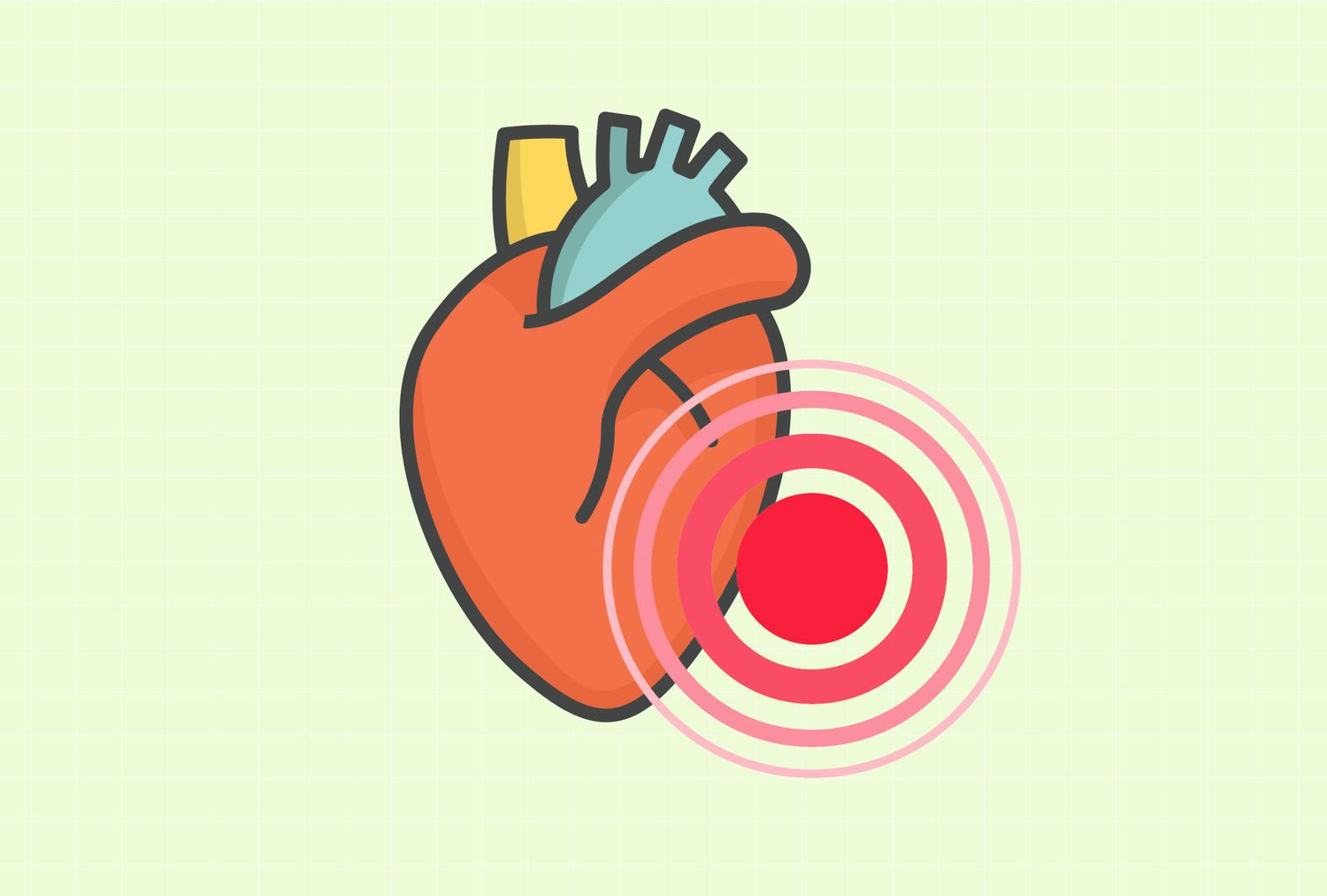 La inflamación crónica puede causar altos niveles de colesterol al reducir el colesterol HDL, que es una buena bola, y aumentar el colesterol LDL, que es una pelota mala. También provoca la liberación de sustancias que aumentan el colesterol en las paredes arteriales, causando arteriosclerosis y enfermedad cardíaca. Por el contrario, el alto colesterol daña los vasos sanguíneos y promueve la inflamación.